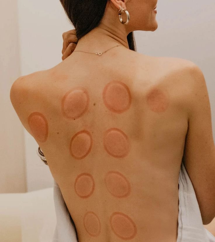 Cupping & Guasha